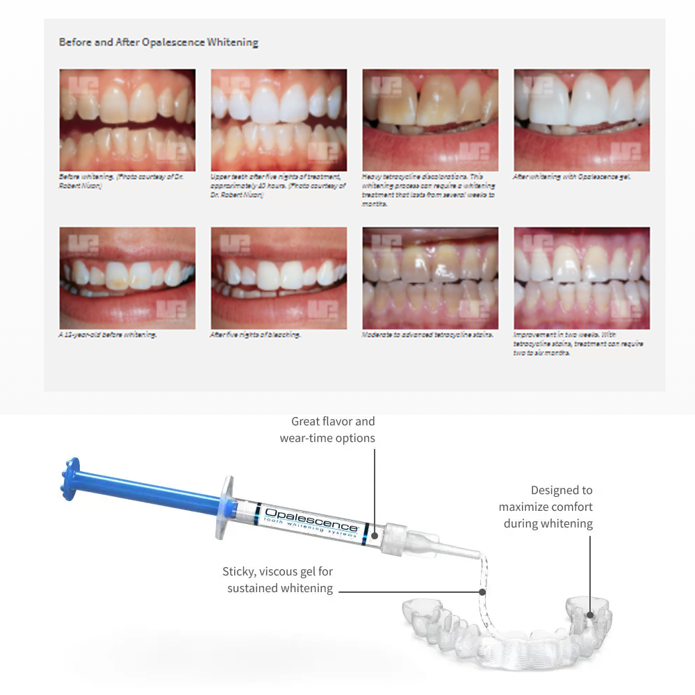 Opalescence Whitening 20% PF 2 - огляд і ціна Teeth Whitening Near Me