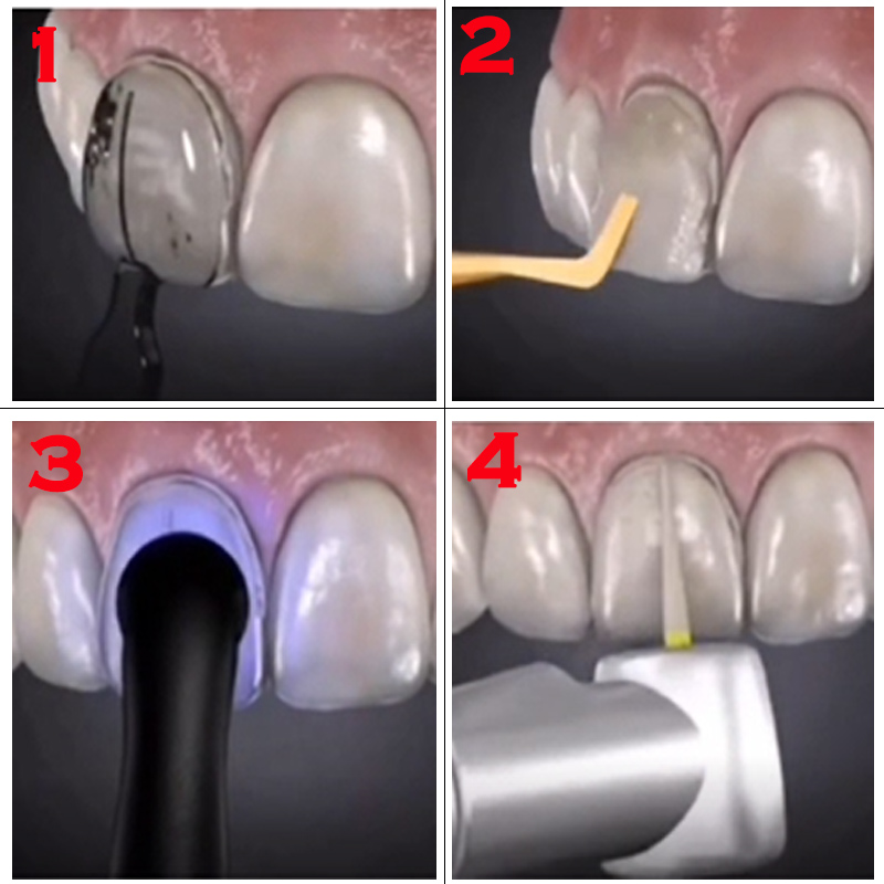 Autoclavable Dental Veneer Mou - огляд і ціна Teeth Whitening Moulds